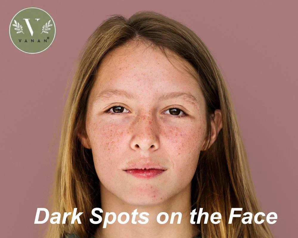 Dark spots on the face